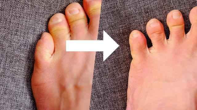 Effektive Übungen zur Linderung von Schneiderballen-Beschwerden