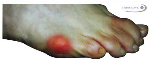 Erfolgreiche Methoden zur Selbstbehandlung des Schneiderballens