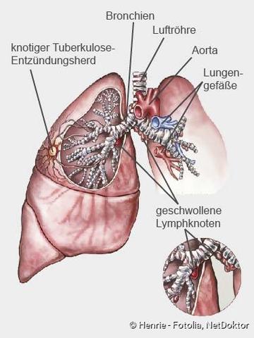 Schwindsucht (Tuberkulose): Eine Infektionskrankheit der Lunge