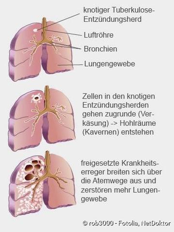 Tuberkulose (Schwindsucht): Ursachen, Symptome und Behandlung