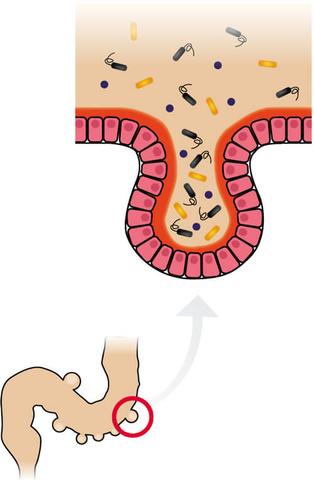 Sigmadivertikulose und Ernährung: Wie eine ballaststoffreiche Kost helfen kann Sigmadivertikulose und Ernährung: Wie eine ballaststoffreiche Kost helfen kann
