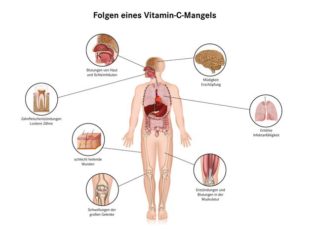 Wie man Skorbut verhindern kann: Die Bedeutung von ausreichend Vitamin C Wie man Skorbut verhindern kann: Die Bedeutung von ausreichend Vitamin C