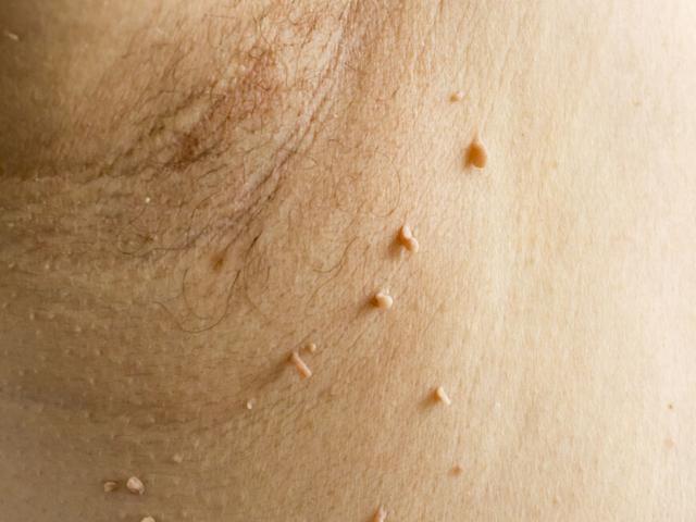 Stielwarzen loswerden: Die besten Methoden zur Selbstbehandlung Stielwarzen loswerden: Die besten Methoden zur Selbstbehandlung