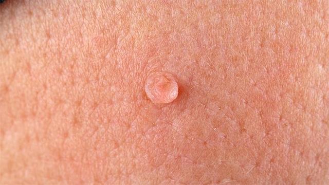 Stielwarzen im Intimbereich: Wann zum Arzt und wann selbst behandeln? Stielwarzen im Intimbereich: Wann zum Arzt und wann selbst behandeln?