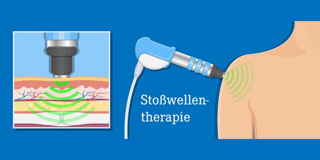 Stoßwellentherapie Zuhause: Wichtige Informationen vor dem Kauf eines Geräts Stoßwellentherapie Zuhause: Wichtige Informationen vor dem Kauf eines Geräts