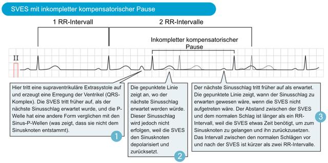 SVES oder VES: Welche Art von Extrasystolen birgt das größere Risiko für die Gesundheit? SVES oder VES: Welche Art von Extrasystolen birgt das größere Risiko für die Gesundheit?