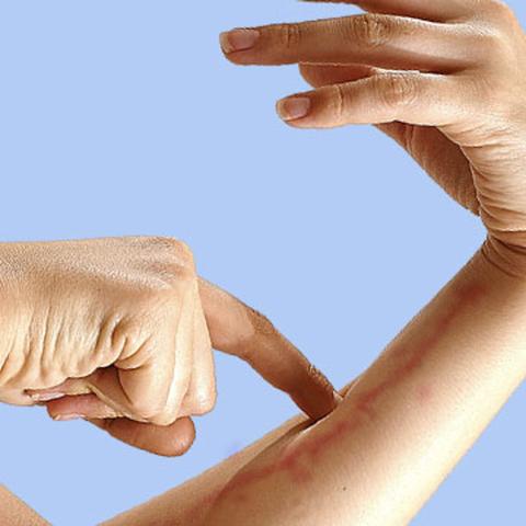 Erkennungszeichen für eine Blutvergiftung: Was bedeuten die Streifen auf der Haut? Erkennungszeichen für eine Blutvergiftung: Was bedeuten die Streifen auf der Haut?