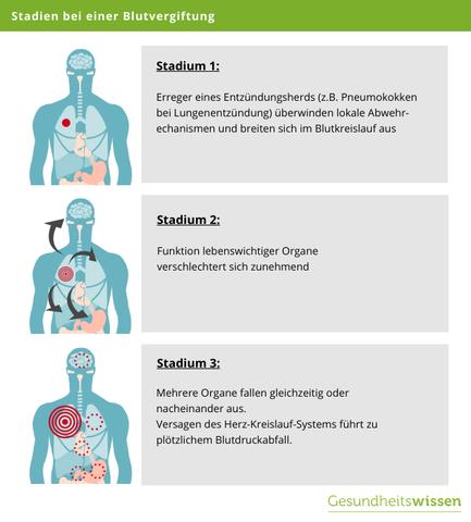Anzeichen einer Blutvergiftung erkennen: Symptome und Handlungsbedarf Anzeichen einer Blutvergiftung erkennen: Symptome und Handlungsbedarf
