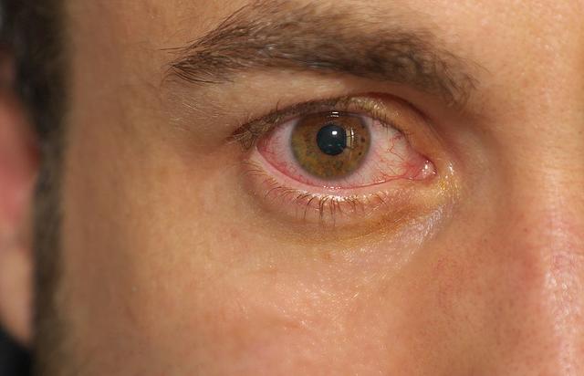 Wie sieht eine Bindehautentzündung aus? Symptome im Überblick Wie sieht eine Bindehautentzündung aus? Symptome im Überblick