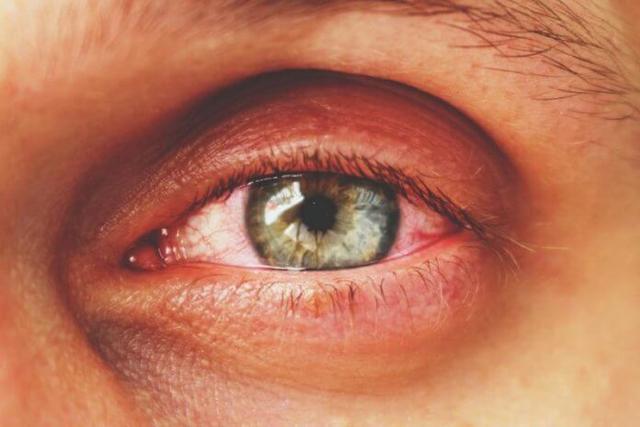 Visuelle Merkmale einer Konjunktivitis: Wie erkennt man eine Bindehautentzündung? Visuelle Merkmale einer Konjunktivitis: Wie erkennt man eine Bindehautentzündung?