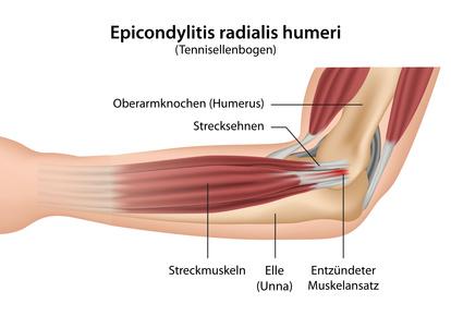 Wie lässt sich ein Tennisarm behandeln? Wie lässt sich ein Tennisarm behandeln?