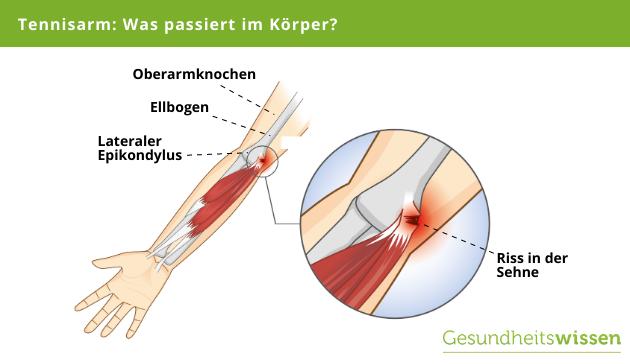 Effektive Maßnahmen gegen Tennisarm-Beschwerden Effektive Maßnahmen gegen Tennisarm-Beschwerden
