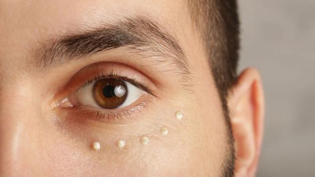 Effektive Hausmittel gegen Tränensäcke: Tipps und Tricks Effektive Hausmittel gegen Tränensäcke: Tipps und Tricks