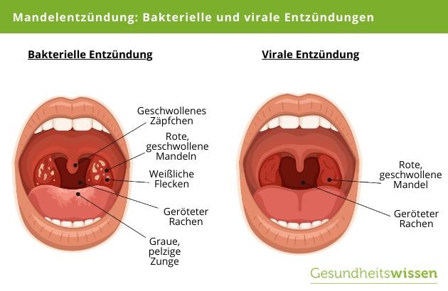 Immunsystem stärken bei Mandelentzündung: Die richtige Ernährung und Lebensweise