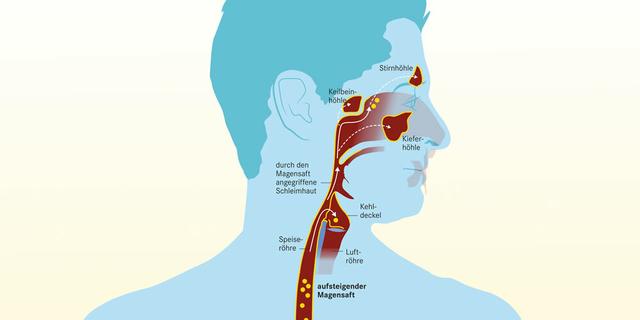 Behandlungsmöglichkeiten für das Einatmen von Magensäure in der Nacht