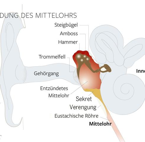 Hilfreiche Tipps bei Hörproblemen nach einer Mittelohrentzündung