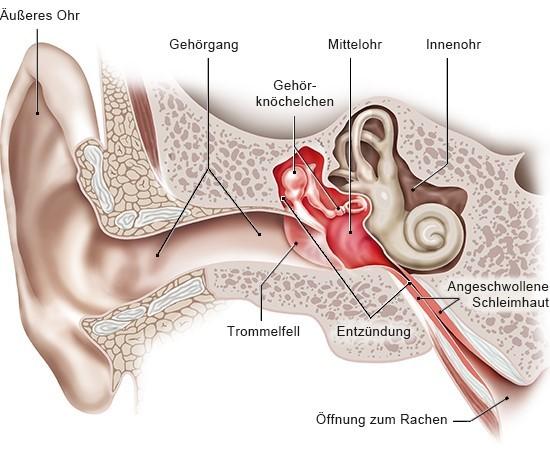 Maßnahmen zur Verbesserung des Hörvermögens nach einer Mittelohrentzündung