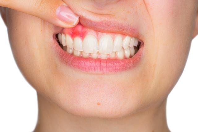Unterschied zwischen Parodontitis und Gingivitis: Was Sie wissen sollten Unterschied zwischen Parodontitis und Gingivitis: Was Sie wissen sollten