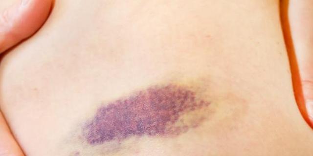 Die Wissenschaft hinter einem Knutschfleck: Wie entsteht er und wie geht er weg? Die Wissenschaft hinter einem Knutschfleck: Wie entsteht er und wie geht er weg?