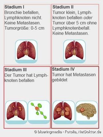 Der Verlauf von Lungenkrebs im Endstadium: Symptome und Prognose Der Verlauf von Lungenkrebs im Endstadium: Symptome und Prognose