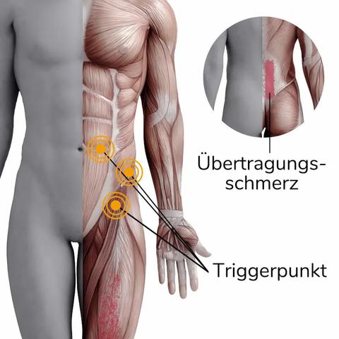 Die Bedeutung von Triggerpunkten für unseren Körper: Ursachen, Auswirkungen und Behandlung Die Bedeutung von Triggerpunkten für unseren Körper: Ursachen, Auswirkungen und Behandlung