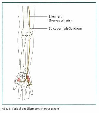 Tipps zur Selbstbehandlung des Ulnarisrinnensyndroms Tipps zur Selbstbehandlung des Ulnarisrinnensyndroms