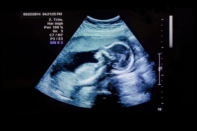 Ultraschall oder Sonographie: Was ist der genaue Unterschied?