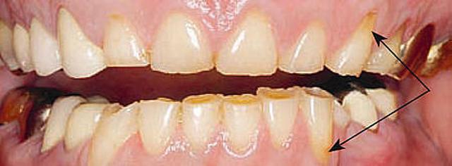 Kostenübernahme bei der Behandlung von nächtlichem Zähneknirschen