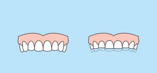 Ursachen und Folgen von nächtlichem Zähneknirschen: Eine Übersicht