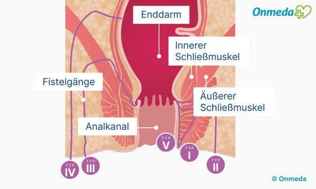 Alles Wissenswerte über Fisteln: Ursachen, Symptome und Therapie Alles Wissenswerte über Fisteln: Ursachen, Symptome und Therapie
