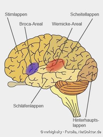 Was ist Aphasie? Ursachen, Symptome und Verlauf erklärt Was ist Aphasie? Ursachen, Symptome und Verlauf erklärt