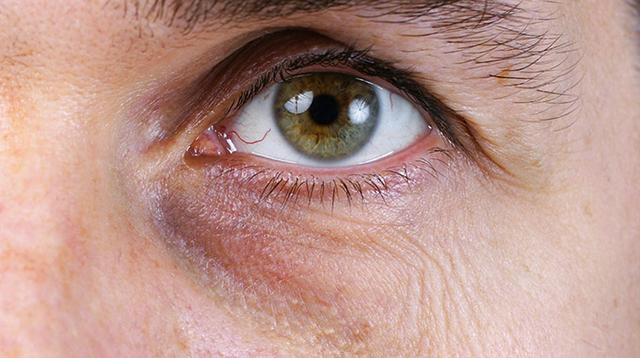 Augenringe: Was steckt hinter den dunklen Schatten?