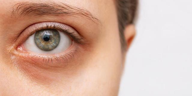 Wie entstehen Augenringe? Ein Blick auf die verschiedenen Faktoren