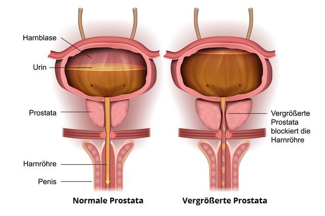 Empfehlungen für die Zeit nach einer Prostataoperation Empfehlungen für die Zeit nach einer Prostataoperation
