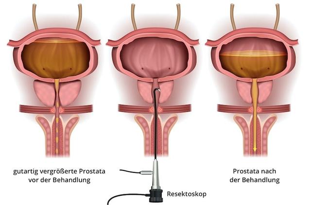 Nach einer Prostataoperation: Was sollte vermieden werden? Nach einer Prostataoperation: Was sollte vermieden werden?