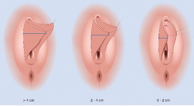 Möglichkeiten zur Verkleinerung der inneren Schamlippen Möglichkeiten zur Verkleinerung der inneren Schamlippen