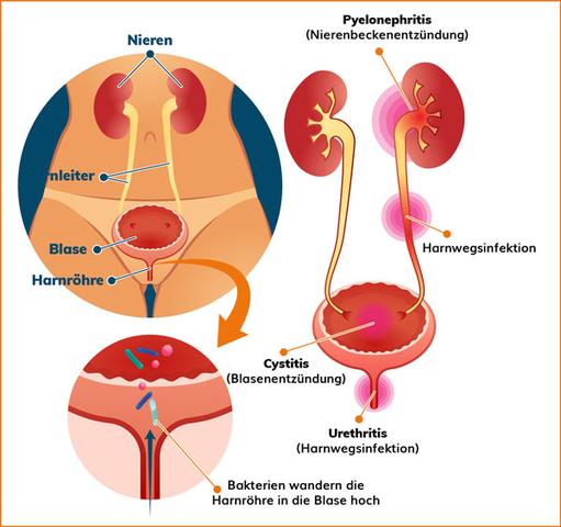 Vermeidung von Blasenentzündungen nach dem Geschlechtsverkehr - Was Sie wissen sollten Vermeidung von Blasenentzündungen nach dem Geschlechtsverkehr - Was Sie wissen sollten