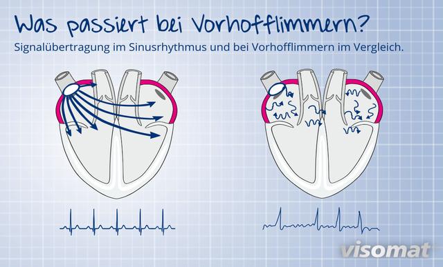Ursachen und Risikofaktoren von Vorhofflimmern Ursachen und Risikofaktoren von Vorhofflimmern