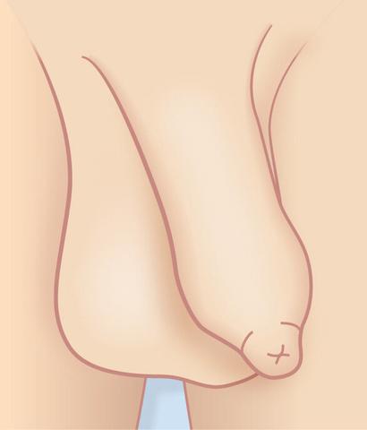 "Phimose bei Kindern: Ab wann ist eine Behandlung notwendig?" "Phimose bei Kindern: Ab wann ist eine Behandlung notwendig?"