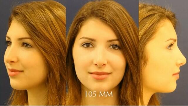 Nach einer Nasen-OP: Wann kann man wieder auf die Stabilität der Nase vertrauen? Nach einer Nasen-OP: Wann kann man wieder auf die Stabilität der Nase vertrauen?