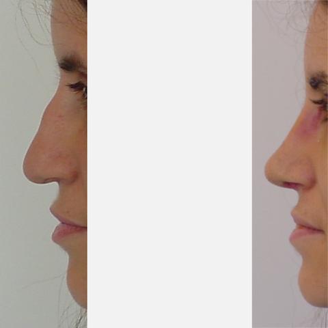 Ab wann ist die Nase nach einer OP wieder belastbar und stabil? Ab wann ist die Nase nach einer OP wieder belastbar und stabil?