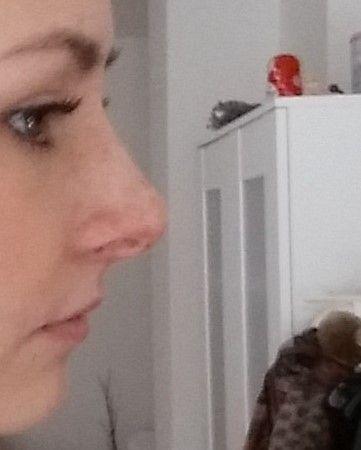 Wie lange dauert es, bis sich die Nase nach einer Operation vollständig erholt und stabilisiert? Wie lange dauert es, bis sich die Nase nach einer Operation vollständig erholt und stabilisiert?