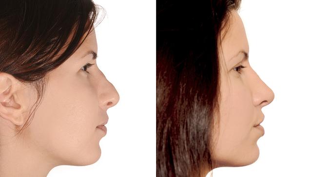 Wann ist die Nase nach einer Operation wieder stabil? Wann ist die Nase nach einer Operation wieder stabil?