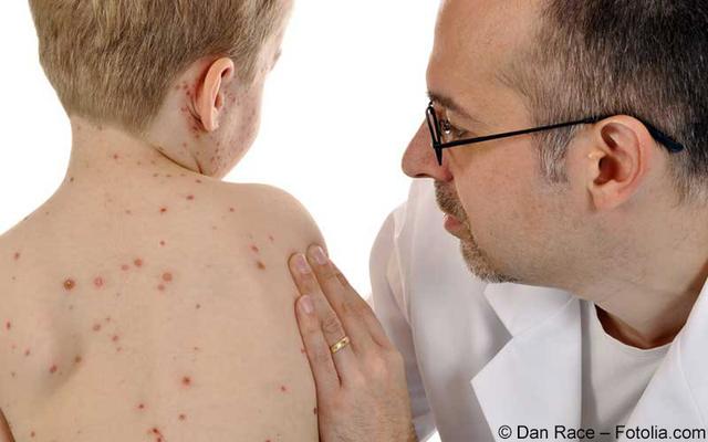 Seit wann gibt es die Impfung gegen Windpocken? Seit wann gibt es die Impfung gegen Windpocken?