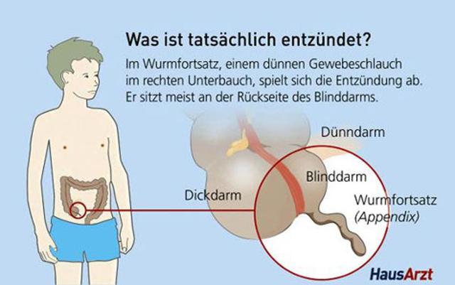 Blinddarmreizung: Wichtige Hinweise für den Krankenhausaufenthalt Blinddarmreizung: Wichtige Hinweise für den Krankenhausaufenthalt