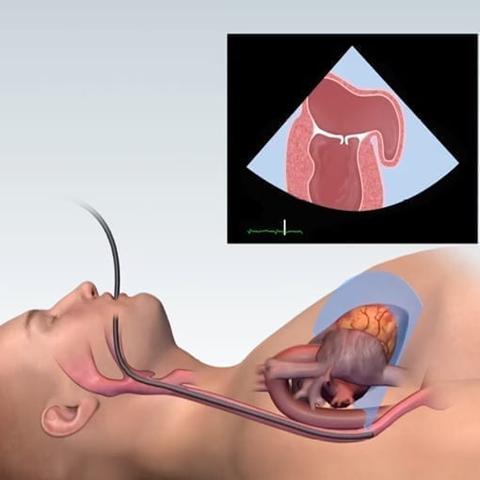 Indikationen für eine Echokardiografie des Herzens Indikationen für eine Echokardiografie des Herzens