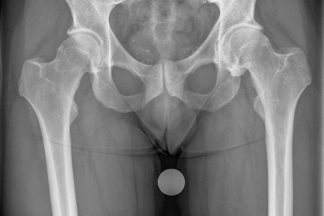 Lebensqualität und Hüftgelenkersatz bei Hüftarthrose Lebensqualität und Hüftgelenkersatz bei Hüftarthrose