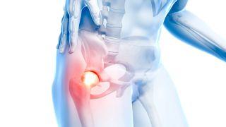 Individuelle Entscheidung: Wann sollte man sich einer Hüft-Operation unterziehen? Individuelle Entscheidung: Wann sollte man sich einer Hüft-Operation unterziehen?