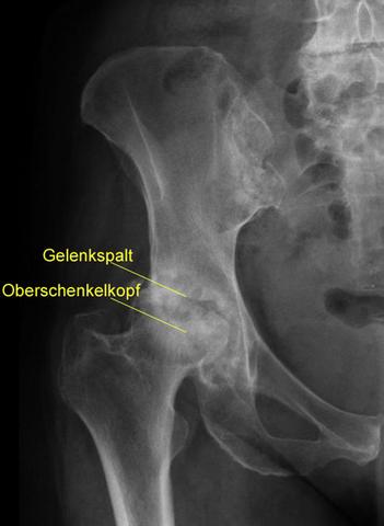 Hüftarthrose: Konservative Therapie oder Operation? Hüftarthrose: Konservative Therapie oder Operation?