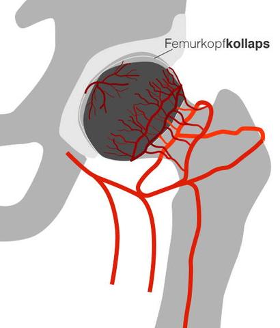 Operative Therapieoptionen bei fortgeschrittener Hüftkopfnekrose Operative Therapieoptionen bei fortgeschrittener Hüftkopfnekrose